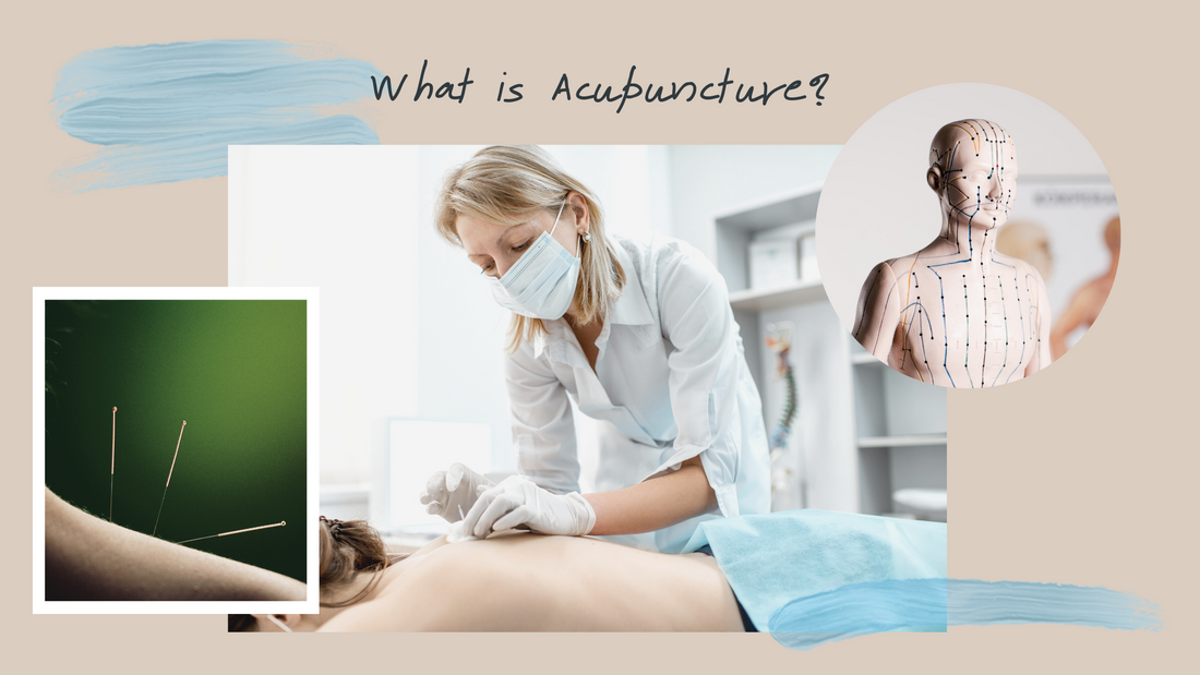 What is Acupuncture?